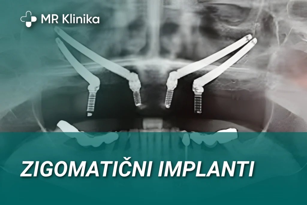 Zigmaticni implanti u kost lobanje