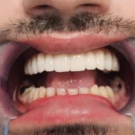 cirkonijum krunica na implantatima