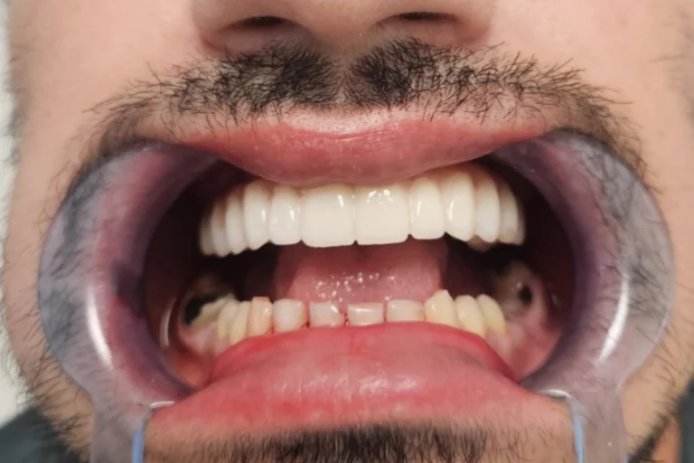 cirkonijum krunica na implantatima