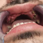 nakon ugradnje implantata