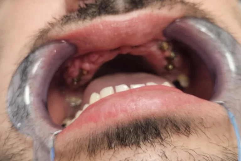 nakon ugradnje implantata