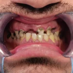 prije ugradnje implantata