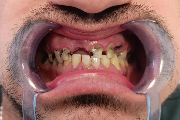 prije ugradnje implantata