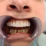 Nakon ugradnje zigmaticnih implanta 1