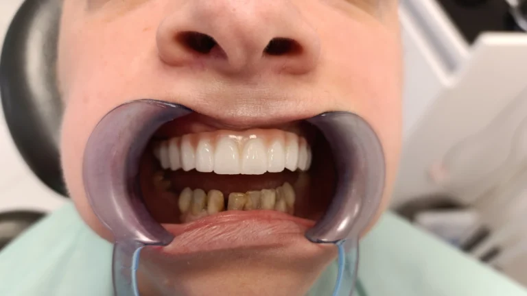 Nakon ugradnje zigmaticnih implanta 1