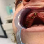 Prije ugradnje implanta 1