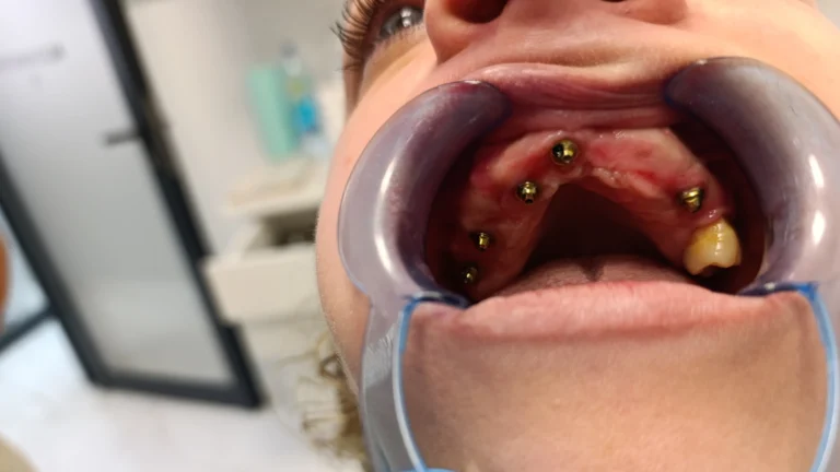 Prije ugradnje implanta 1