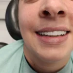 zigmaticni implanti 1