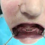 All on 4 primjer rada 4 ugradnja