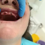 All on 4 primjer rada 4 ugradnja gornja vilica