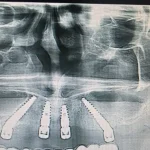 All on 4 primjer rada 5 rtg snimak