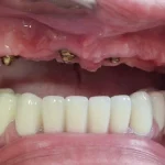 All on 4 primjer rada 5 ugradnja gornja vilica