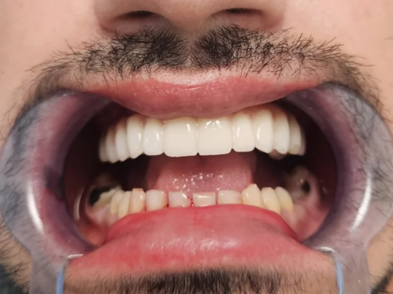 All on X finalni rezultat