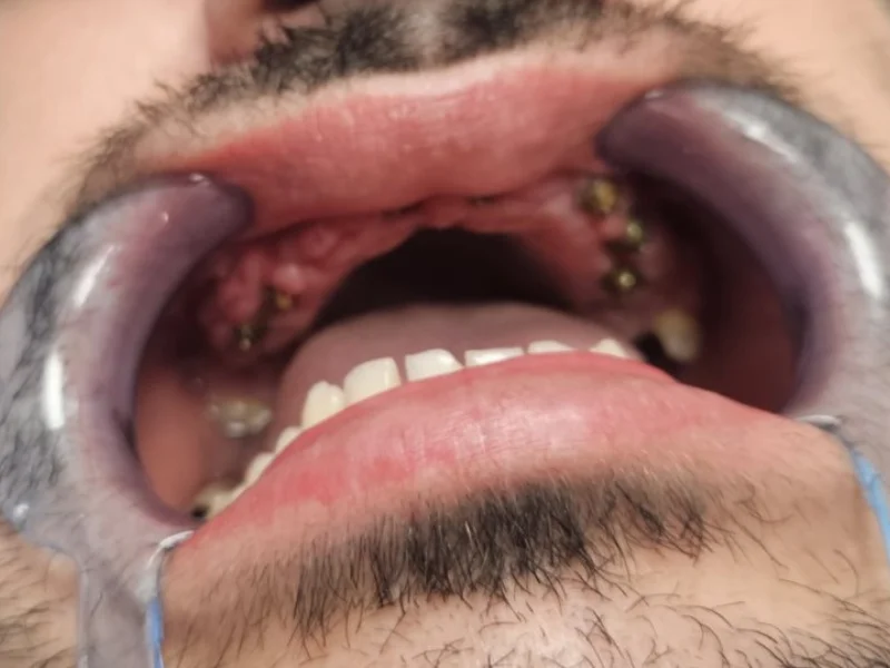 All on X nakon ugradnje 1