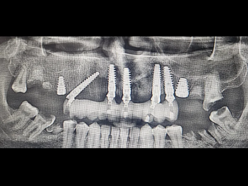 All on X rendgenski snimak nakon ugradnje