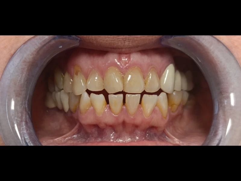 Bezmetalne krunice 1