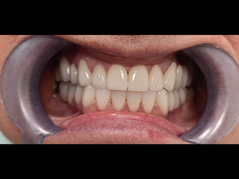 Bezmetalne krunice 2