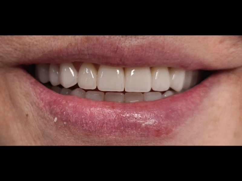 Bezmetalne krunice 3