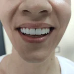 Hollywood smile pac 1