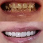 Hollywood smile prije i poslije