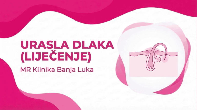 Urasla Dlaka - Pilonidalna Cista (UZROCI I LIJEČENJE)