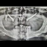 Zigomaticni implanti poslije intervencije rendgenski snimak