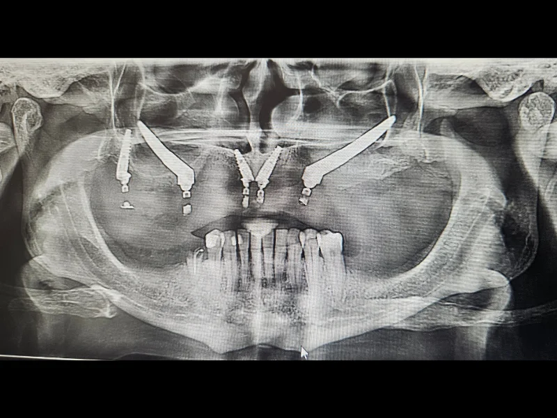 Zigomaticni implanti poslije intervencije rendgenski snimak