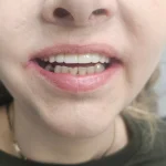 Zigomaticni implanti poslije ugradnje - finalni izgled