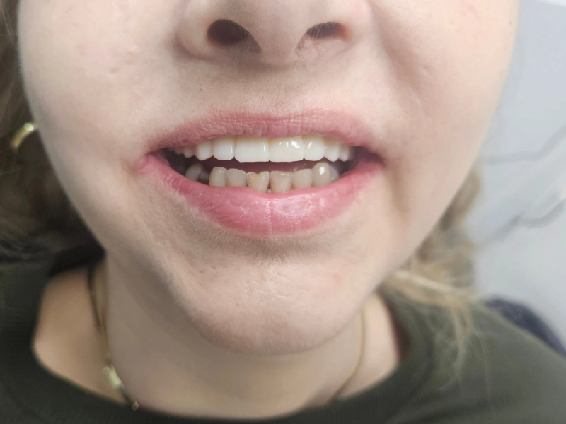 Zigomaticni implanti poslije ugradnje - finalni izgled