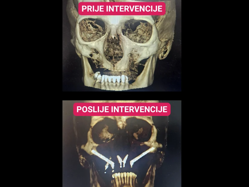Zigomaticni implanti prije i poslije intervencije