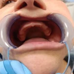 Zigomaticni implanti prije ugradnje slika 1