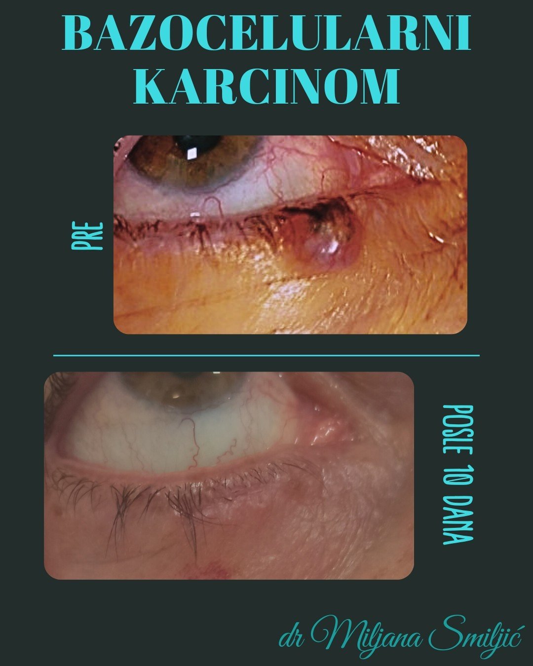 bazocelularni karcinom