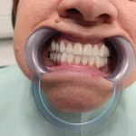 bezmetalne krunice final