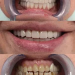 bezmetalne krunice final (2)