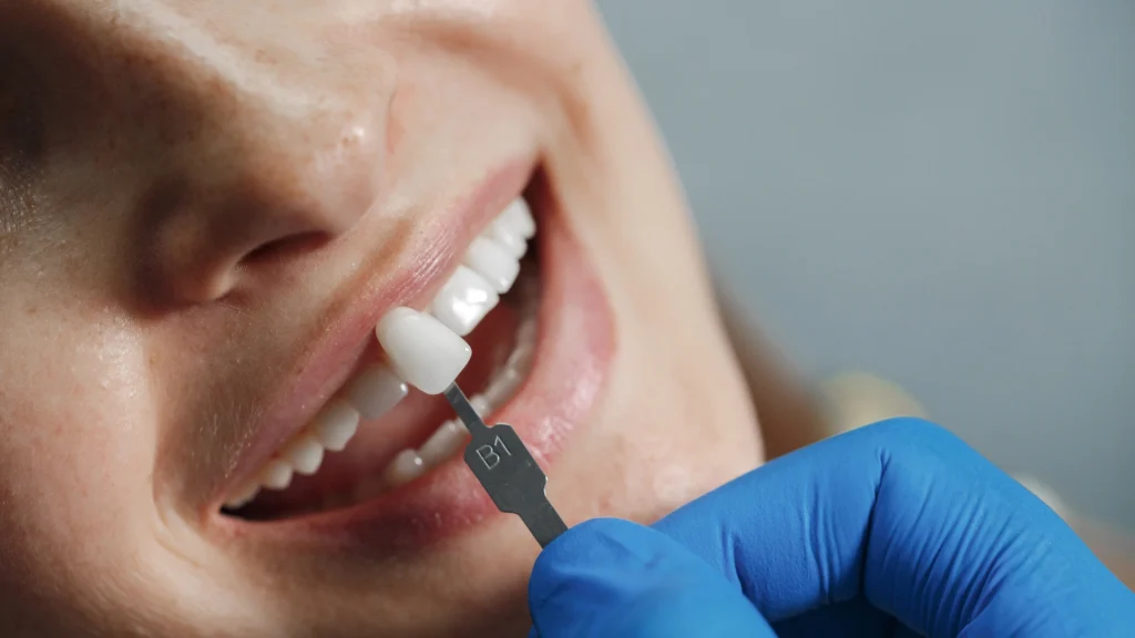 bezmetalne krunice slika 1