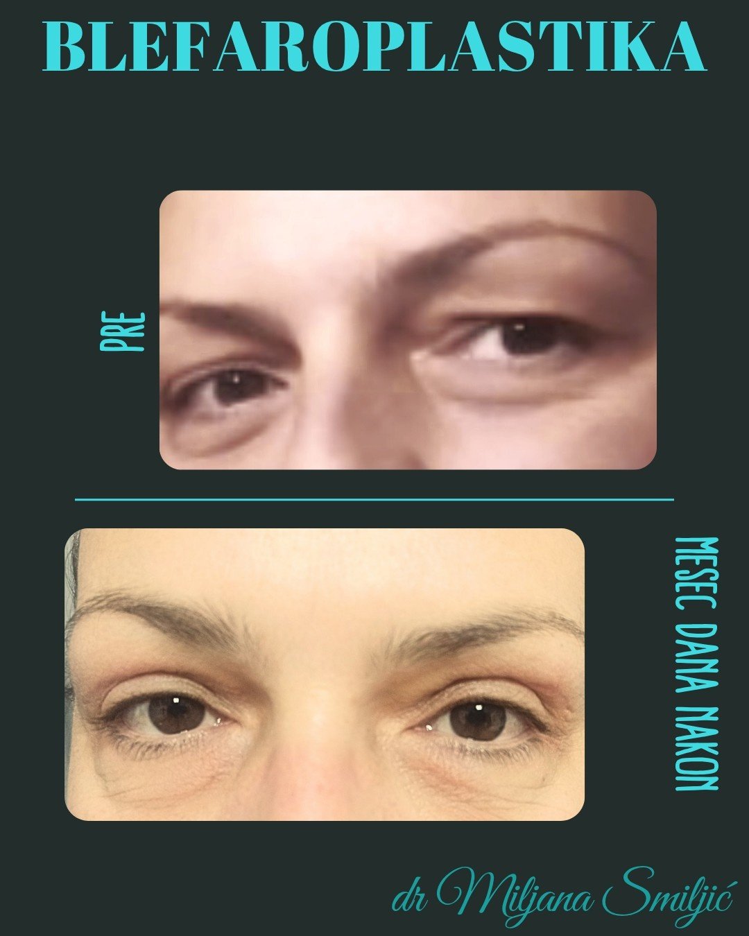 blefaroplastika banja luka