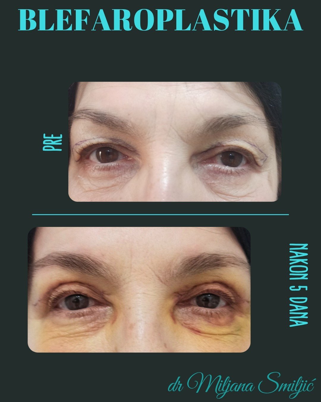 blefaroplastika