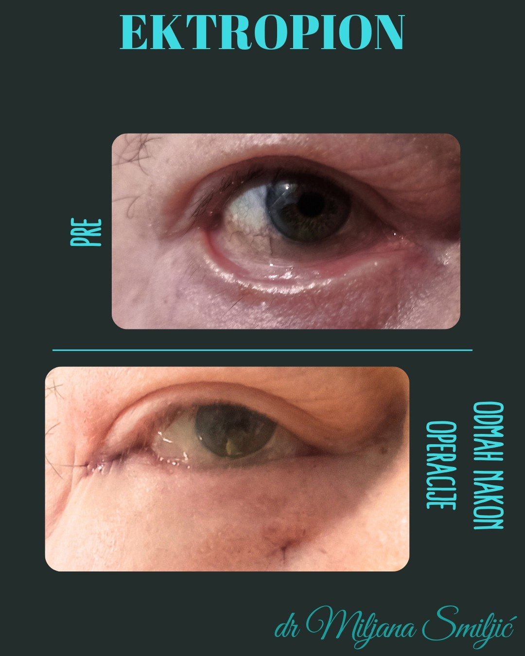 ektropion
