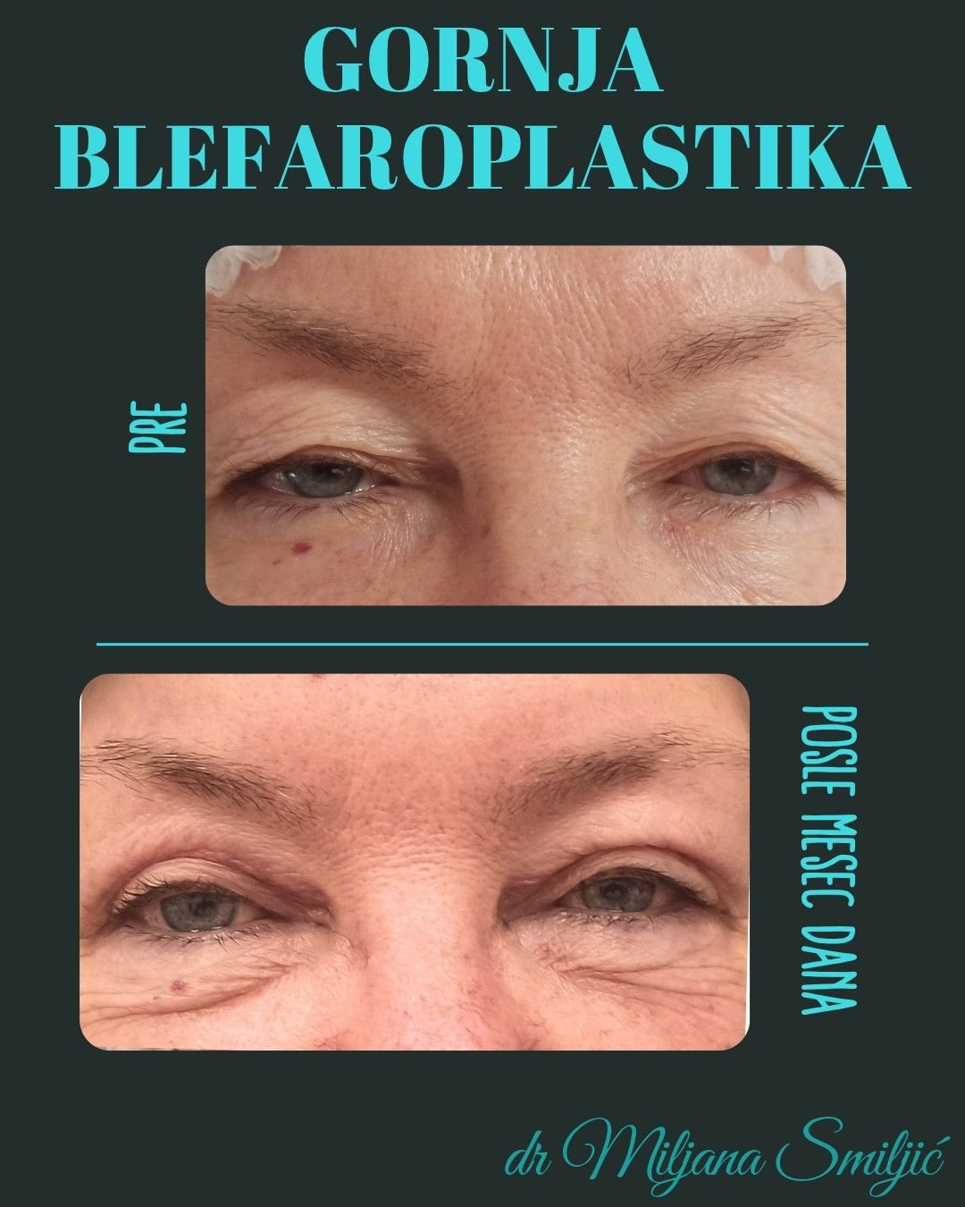 gornja blefaroplastika 2