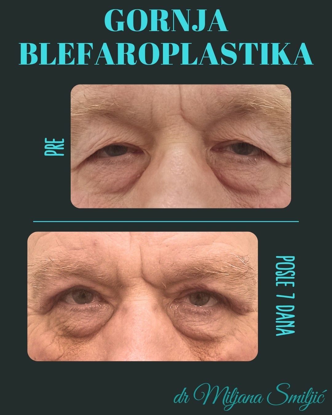 gornja blefaroplastika 3