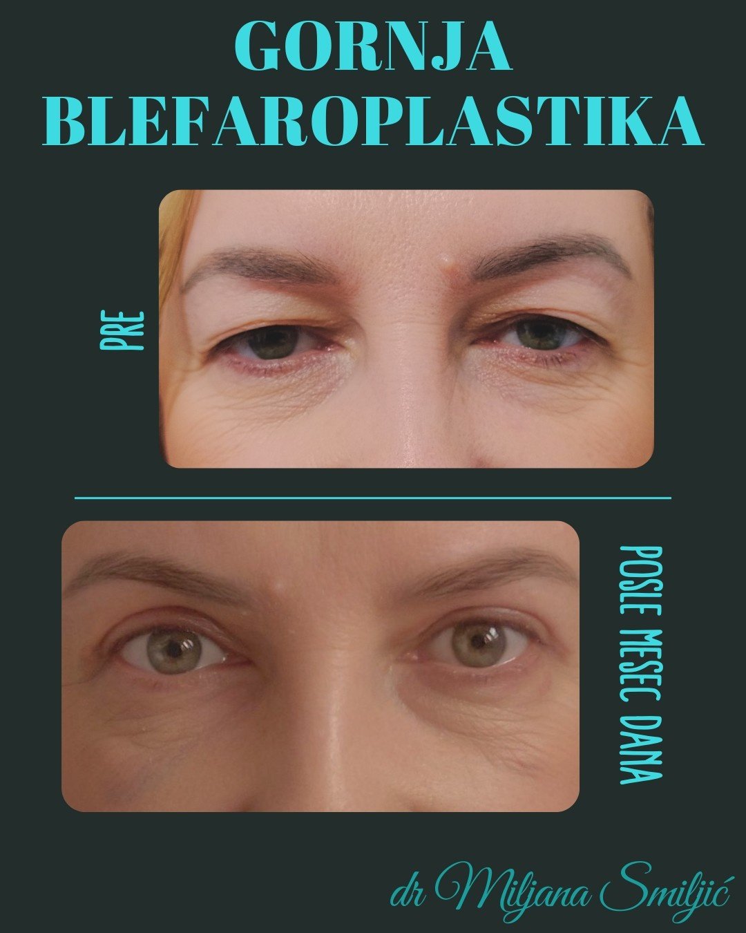 gornja blefaroplastika 4