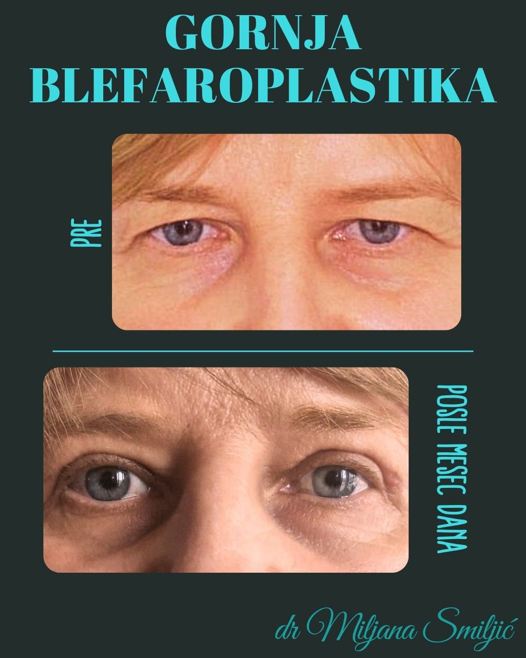 gornja blefaroplastika 5