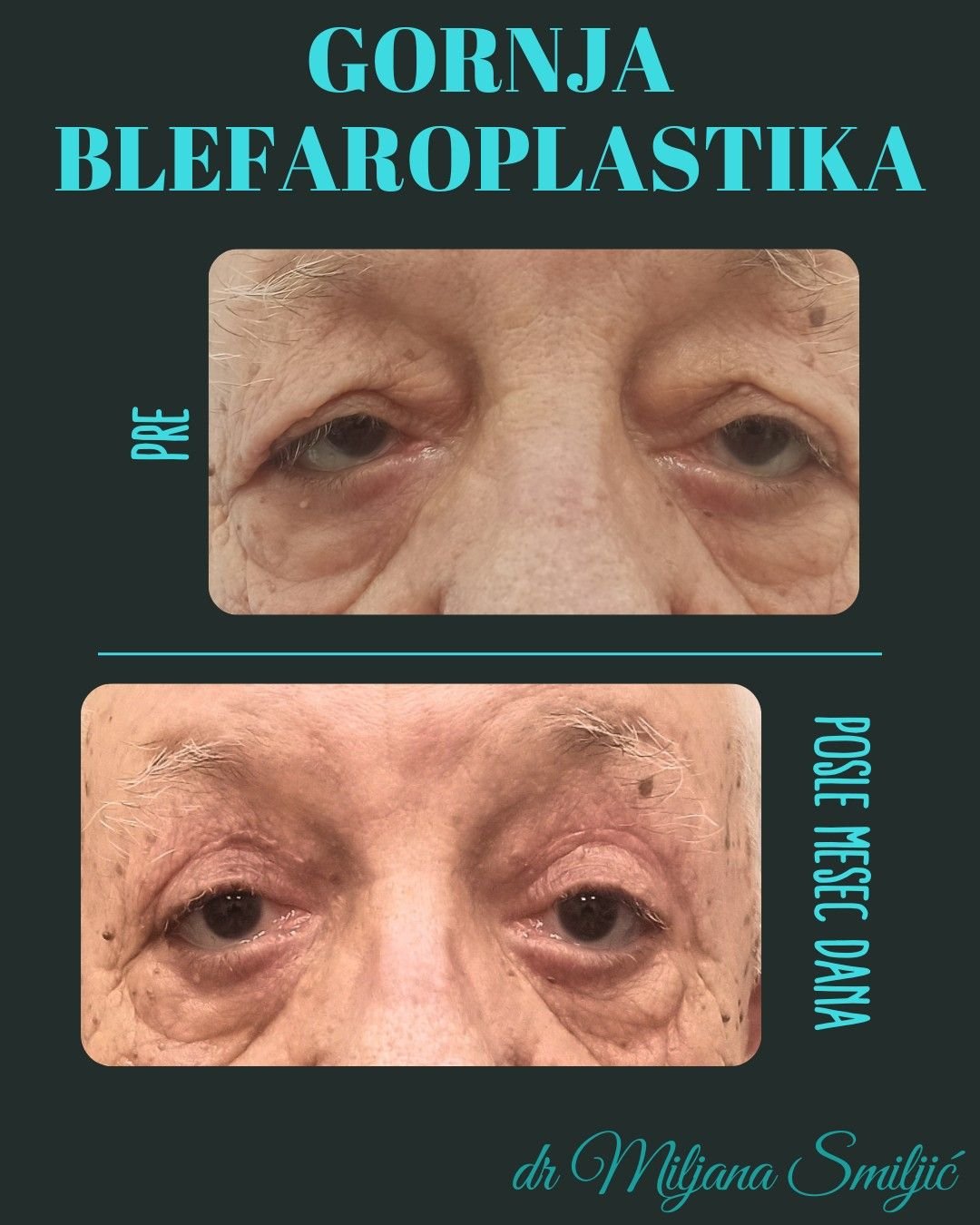 gornja blefaroplastika banja luka