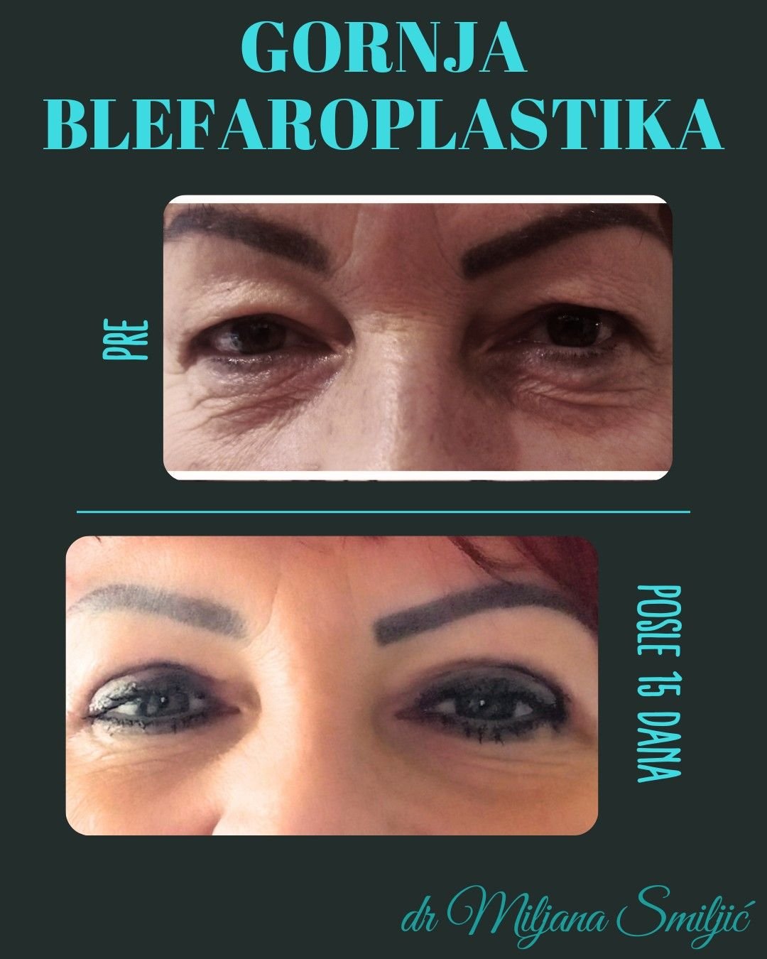 gornja blefaroplastika
