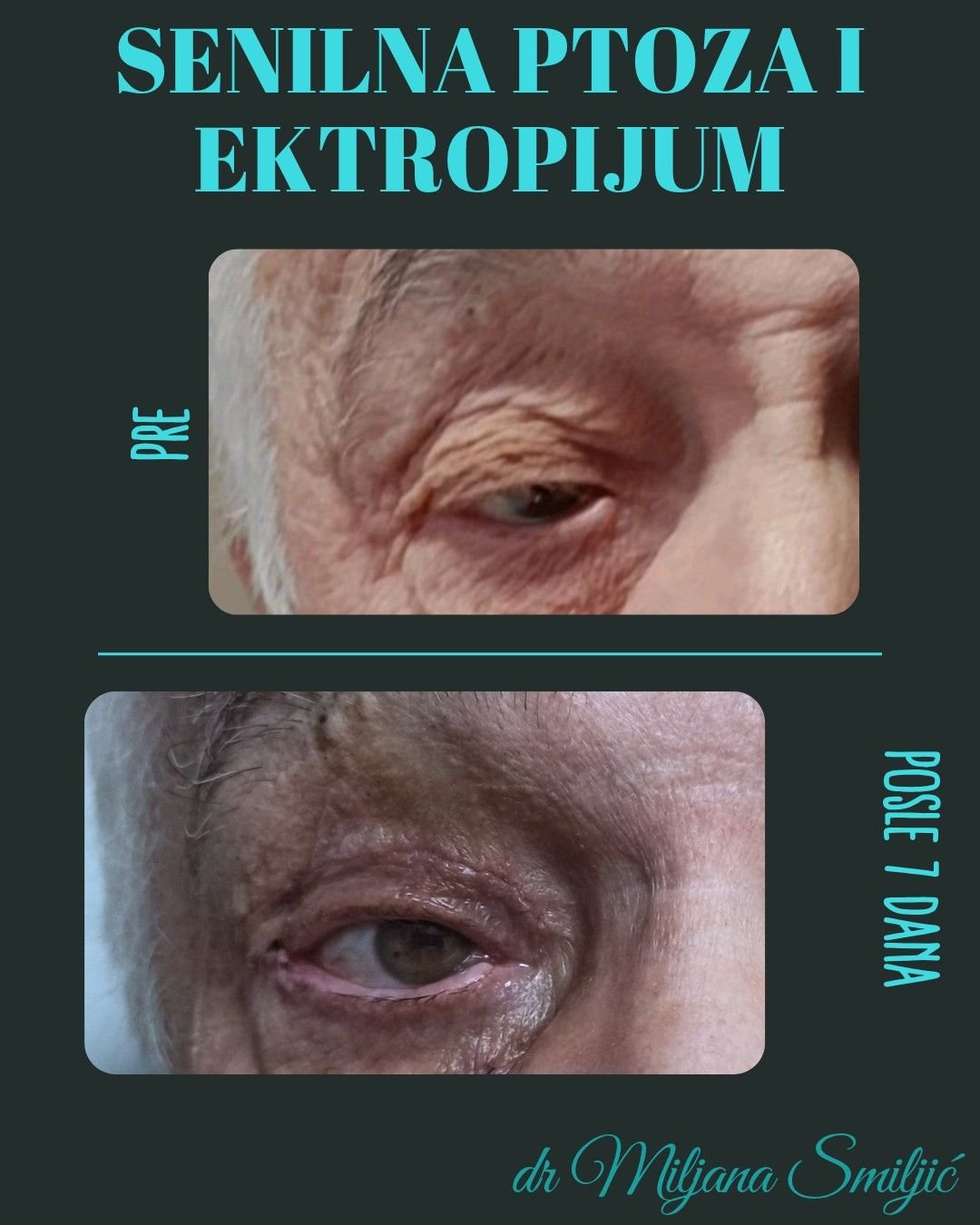 senilna ptoza i ektropijum
