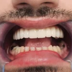 zigomaticni implantati primjer pacijent 1 - rezultat