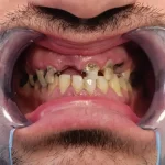 zigomaticni implantati primjeri pacijent 1 - pre izrade