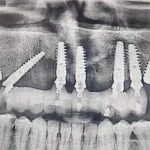 zigomaticni implantati - primjeri pacijent 1 - rendgenski snimak