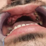 zigomaticni implantati primjeri pacijent 1 - tok tretmana