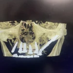 zigomaticni implantati primjeri pacijent 3 - kopjuterski snimak nakon ugradnje